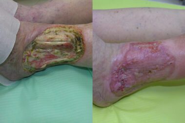 przed i po 9miesiecy po EVLT sklero leczenie farmakologiczne